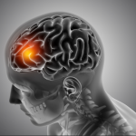 AVC mata um brasileiro a cada 6 minutos